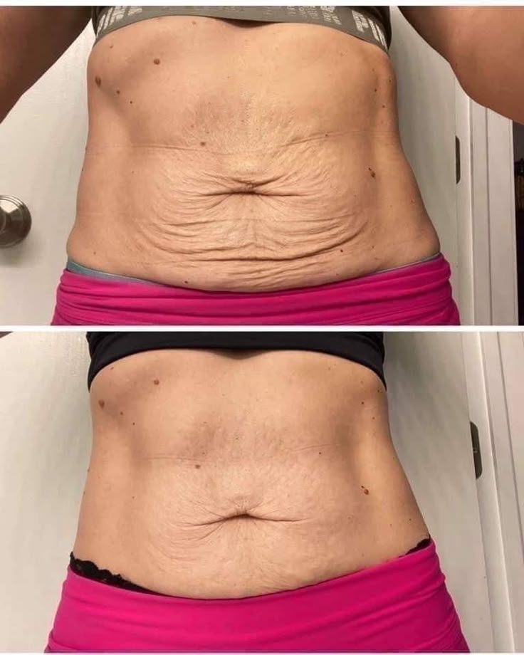 Lost Weight… But Your Skin Didn’t Follow?